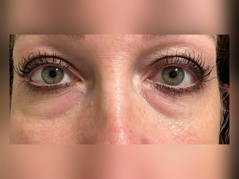 After &mdash; Puffy, lined under-eyes &rarr; Smoother, calmer eye area