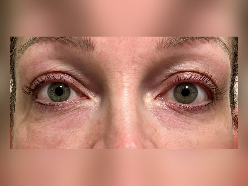Before &mdash; Puffy, lined under-eyes &rarr; Smoother, calmer eye area