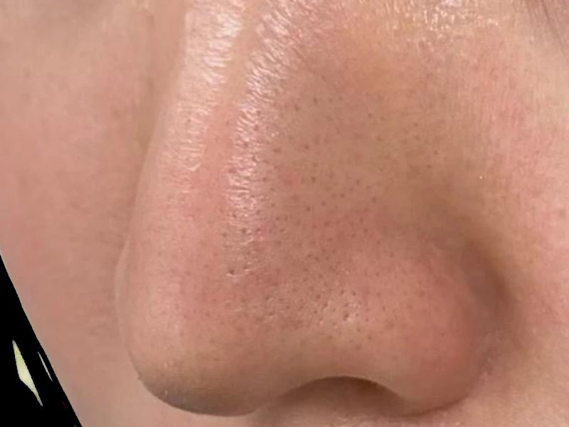 After &mdash; Clogged pores & blackheads &rarr; Clearer, refined texture