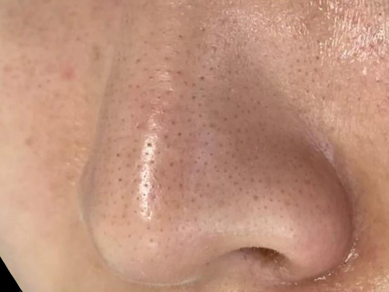 Before &mdash; Clogged pores & blackheads &rarr; Clearer, refined texture