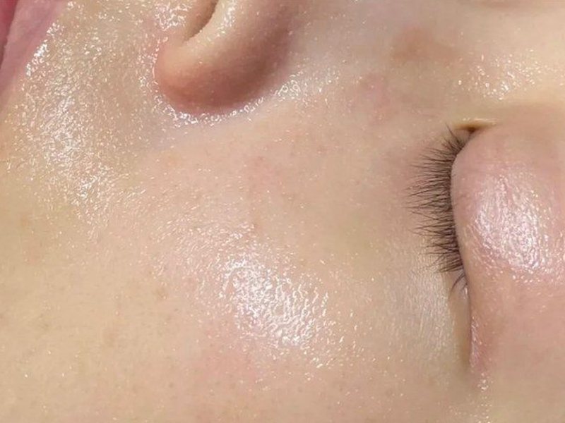After &mdash; Large pores &rarr; Smoother skin & Smaller pores