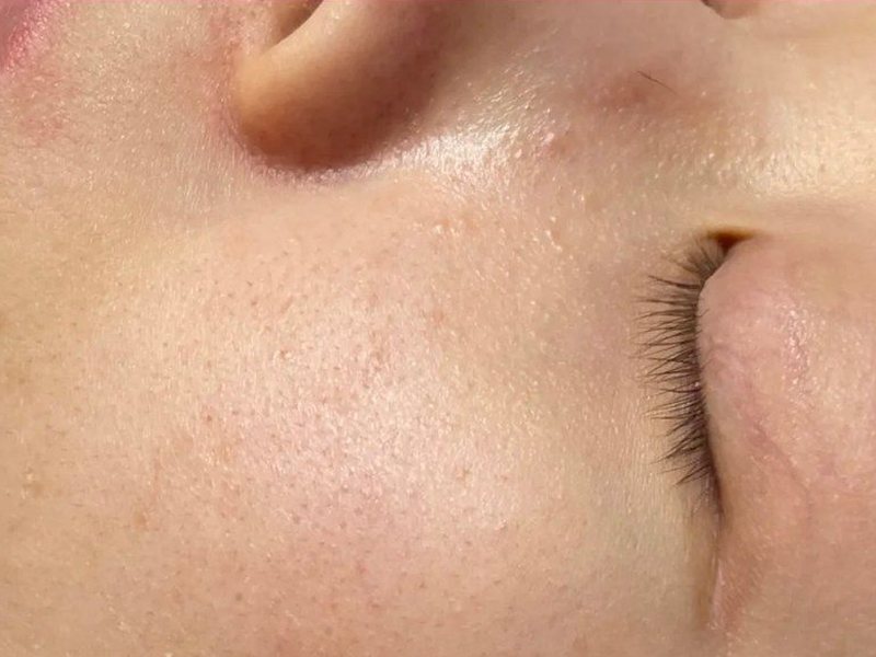 Before &mdash; Large pores &rarr; Smoother skin & Smaller pores