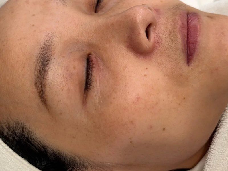 Before &mdash; Pigmentation &rarr; Even skin tone & Faded spots