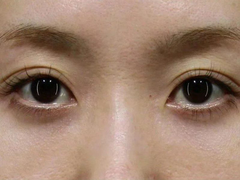 After &mdash; Bags & Tear troughs &rarr; Reduced & Smoother Eye Area