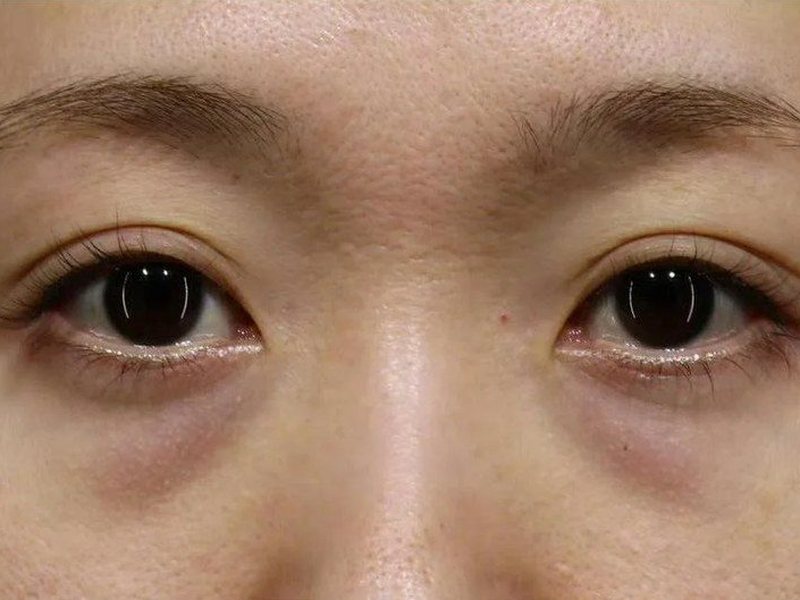 Before &mdash; Bags & Tear troughs &rarr; Reduced & Smoother Eye Area