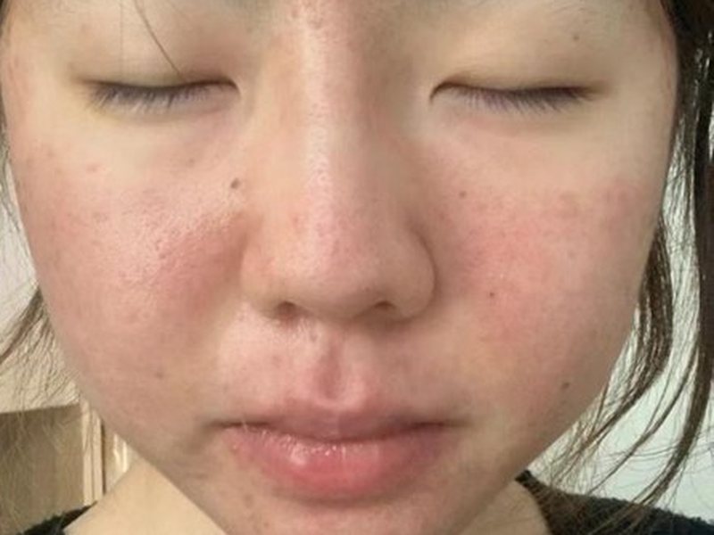 After &mdash; Redness, sensitivity & acne &rarr; Reduced redness, Inflammation & Breakouts