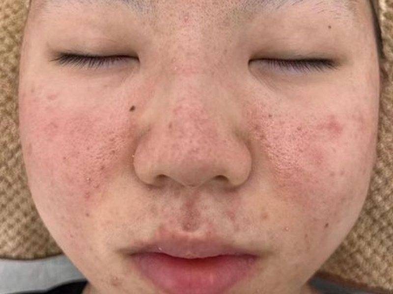 Before &mdash; Redness, sensitivity & acne &rarr; Reduced redness, Inflammation & Breakouts