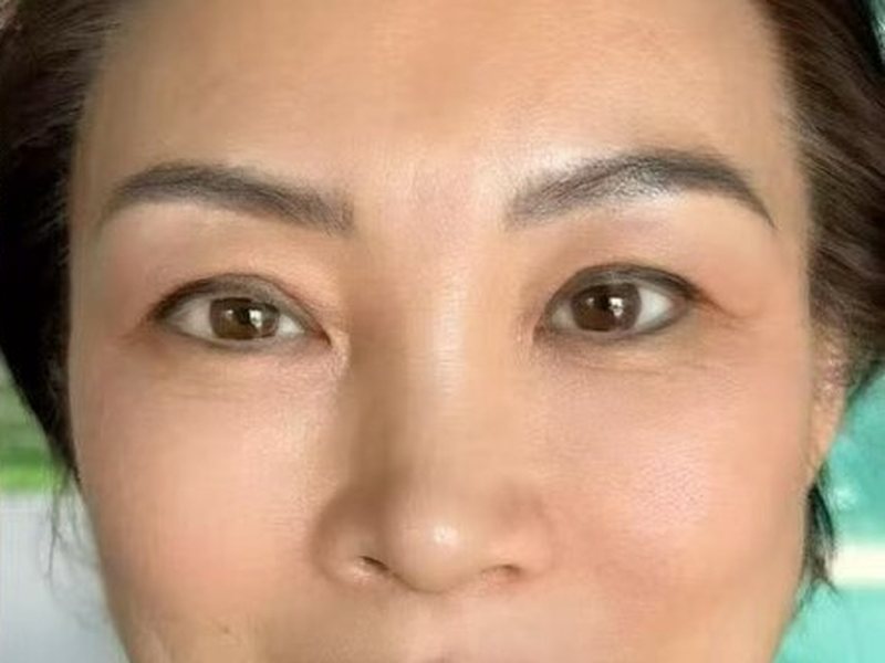 After &mdash; Dull & sagging skin & deep nasolabial folds & tear troughs & large pores &rarr; Brighter & tighter skin & softer folds & even tone