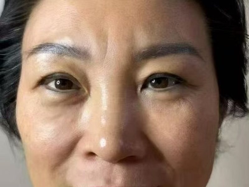 Before &mdash; Dull & sagging skin & deep nasolabial folds & tear troughs & large pores &rarr; Brighter & tighter skin & softer folds & even tone