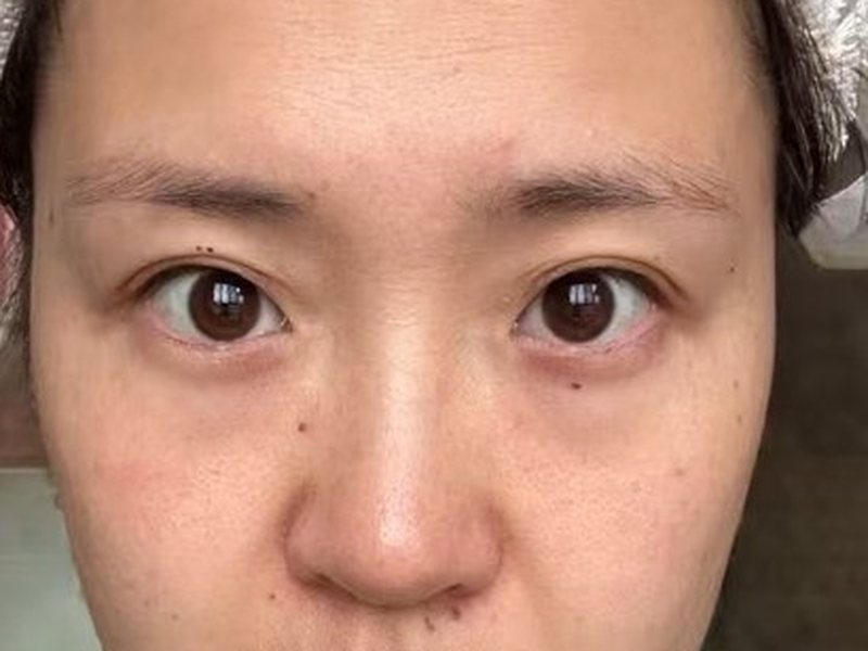 After &mdash; Fine lines & bags & tear troughs & dull rough skin &rarr; Less lines & smoother under-eyes & brighter, tighter skin