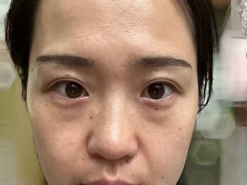 Before &mdash; Fine lines & bags & tear troughs & dull rough skin &rarr; Less lines & smoother under-eyes & brighter, tighter skin