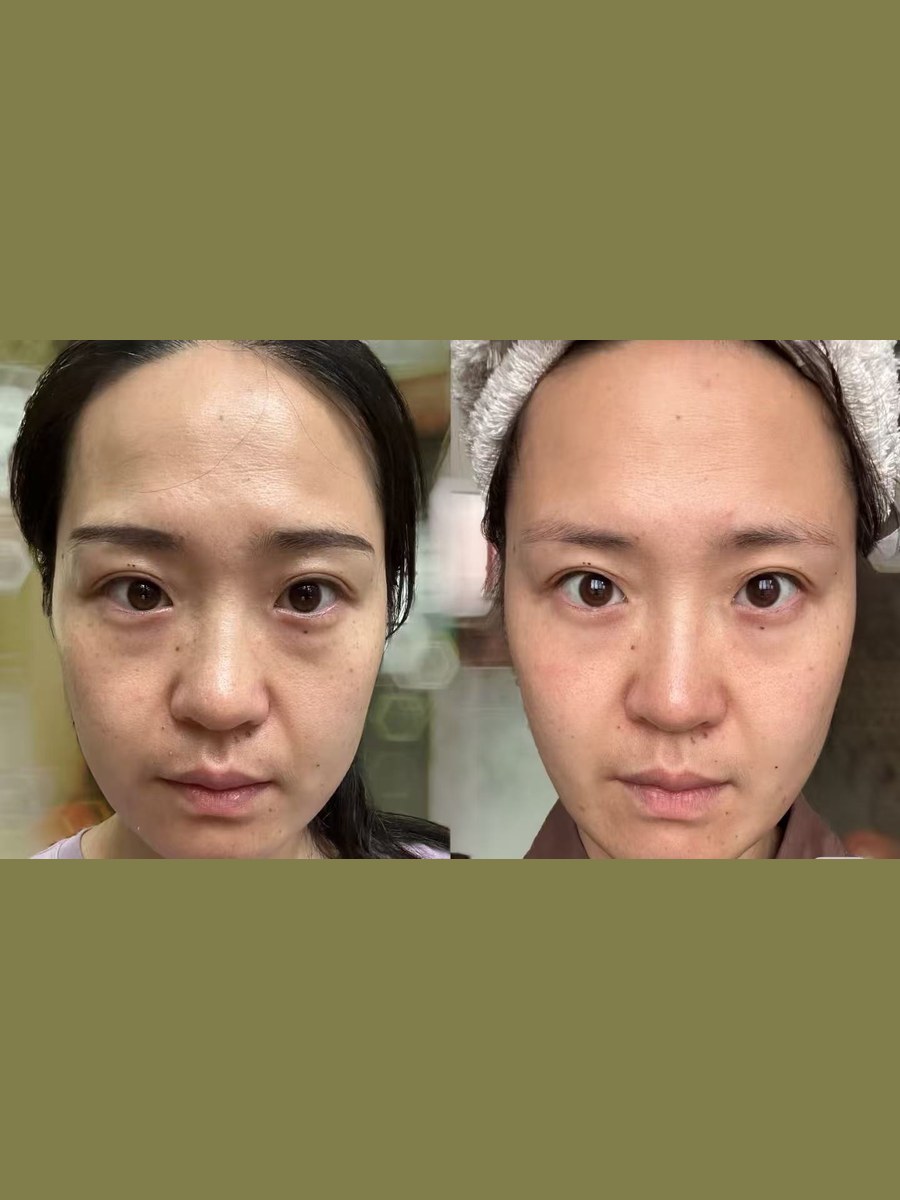 Before and after